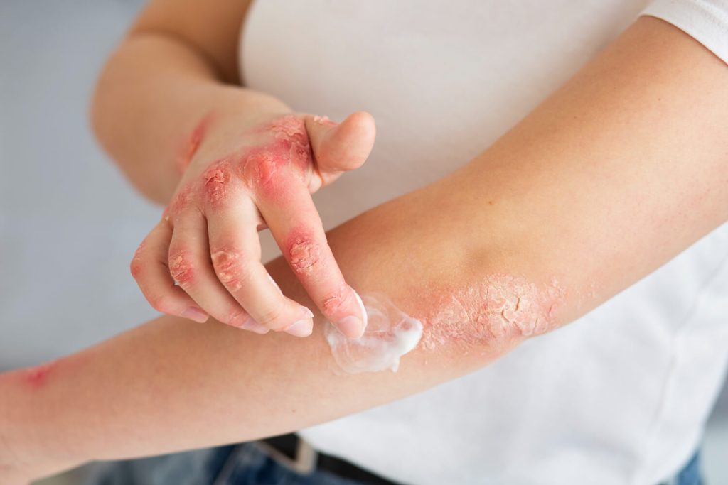 Descubra o Melhor Tratamento para Dermatite Atópica com a Dra. Natalia Estanislau