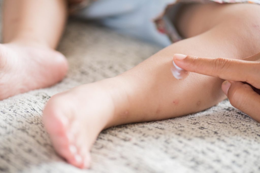 Tratamento para dermatite atópica no Rio de Janeiro
